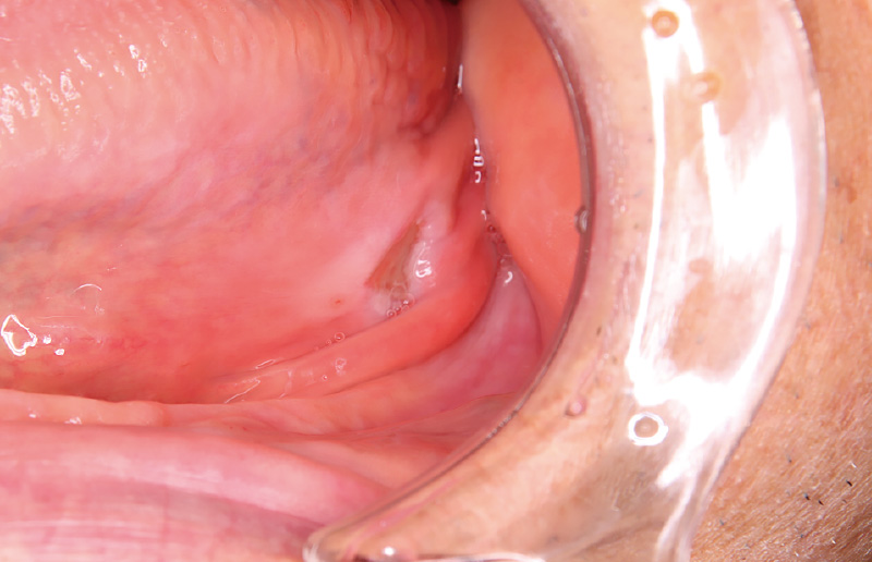 [写真] 義歯不適合による褥瘡性潰瘍