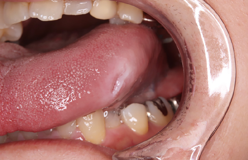 [写真] 誤咬による舌側縁部口内炎
