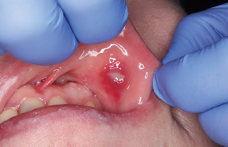 [写真] 誤咬による上唇口内炎