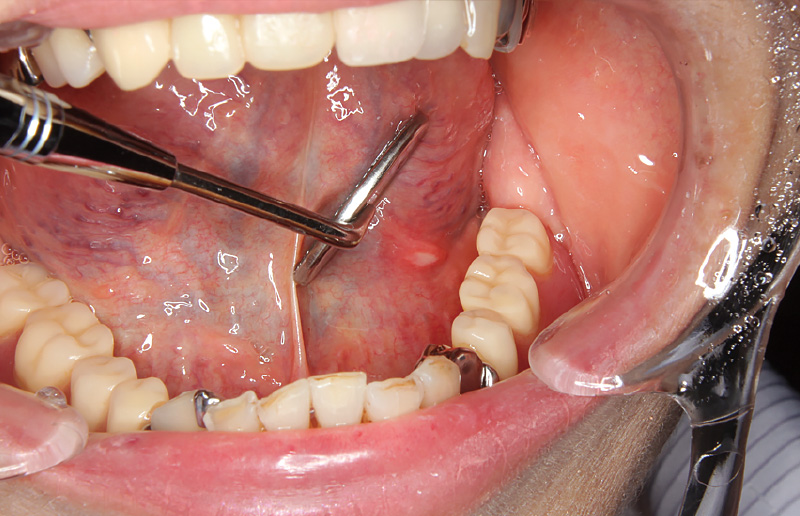 [写真] 舌下面の義歯性口内炎