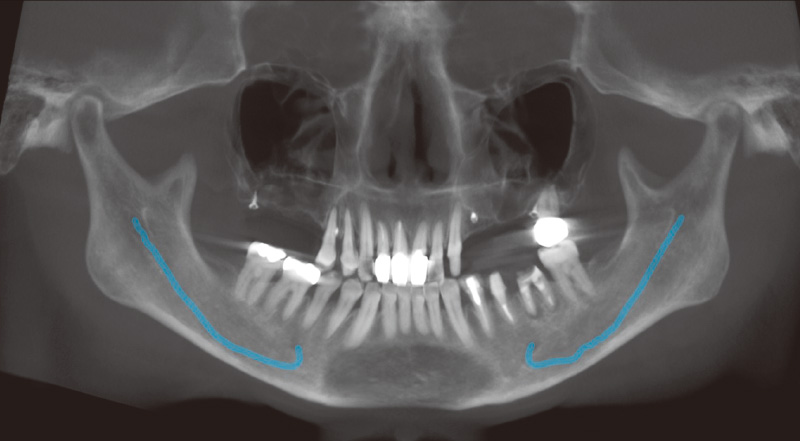 [写真] 再診時のパノラマX線画像