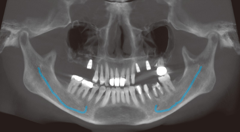 [写真] インプラント埋入後の状態