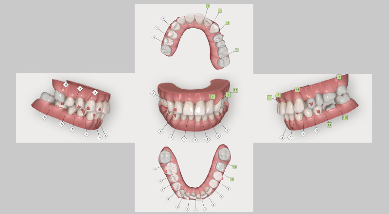 [写真] インプラント埋入後に計画した、クリンチェック治療計画の矯正治療前画像