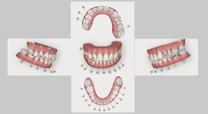 [写真] 「iGo Plus」クリンチェック治療計画の、矯正治療後のシミュレーション画像