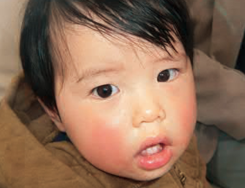 [写真] 常時口が開いている1歳6か月の子ども