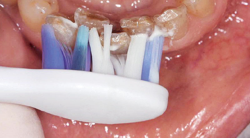 [写真] 「ジェントルプラスブラシ」を使用した口腔ケアの様子