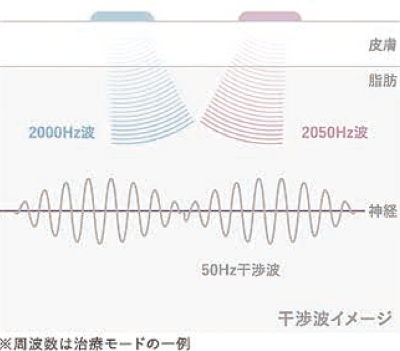 [図] 干渉波刺激療法