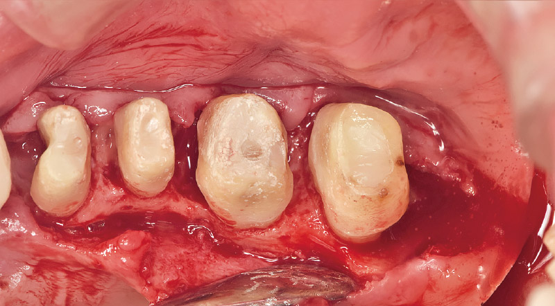 [写真] 「SH」を用いて₇遠心にディスタルウェッジを行い、口蓋側歯肉剥離にも「SH」を用いた。（