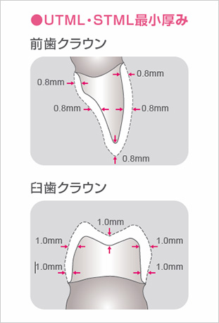 UTML・STML最小厚み