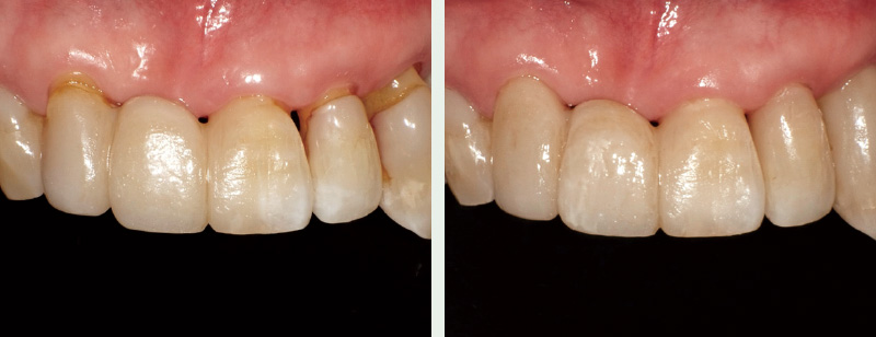 2010年に行った前歯部修復は経年劣化がみられ、マージン部分の着色も見られるようになったので、2022年に前歯部の旧修復材料を削除し、MIの原則にのっとった修復を目指すべく、ここでは「クリアフィルR マジェスティR ES フロー Universal」で充填を行った