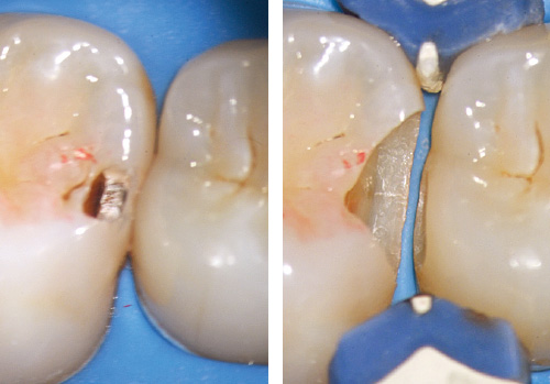 左：クラックに沿ってラウンドバーにて削合していくとエナメル象牙境でう蝕は拡大していた / 右：「3D リテーナー フュージョンS」（ギャリソン・デンタル・ソリューションズ）にて歯間を離開したままう蝕を除去していくことで最小限のエナメル削除量で窩洞形成が可能となる