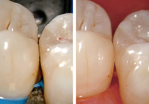 左：充填直後側方面観（口蓋側から） / 右：形態修正、研磨、セパレーター除去後側方面観（口蓋側から）