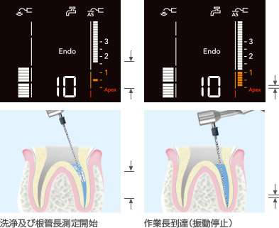 洗浄及び根管長測定の図