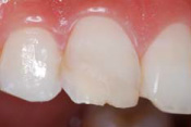 ボンドフィルSB プラスにて歯冠部に破折片を接着し、不足部分には充填した様子