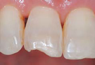 上顎中切歯の外傷切端破折の写真