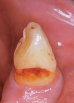 下顎犬歯根面う蝕の写真