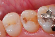 上顎小臼歯隣接面う蝕の写真