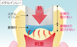 メタルインレーのイメージ