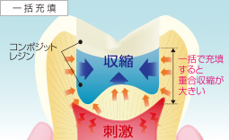 一括充填のイメージ