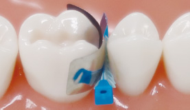 歯頸部をしっかり封鎖した際のイメージ