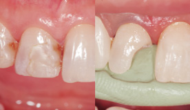 シリコンガイドを製作後窩洞を形成し、舌側の歯冠概形をESフローで作成するイメージ