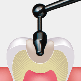 咬合面充填のイメージ