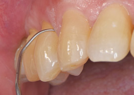 歯肉溝に挿入する写真