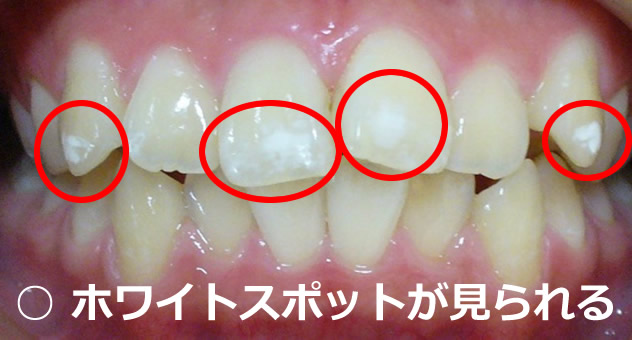 カリエスリスク