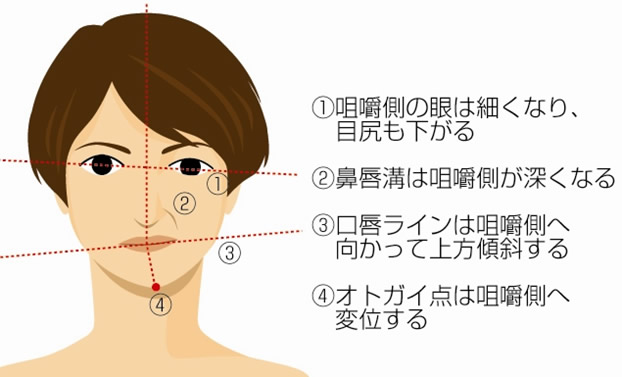 偏咀嚼による非対称性顔貌の特長