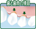歯と歯肉の境目