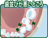 歯並びが悪いところ