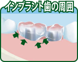 インプラント歯の周囲