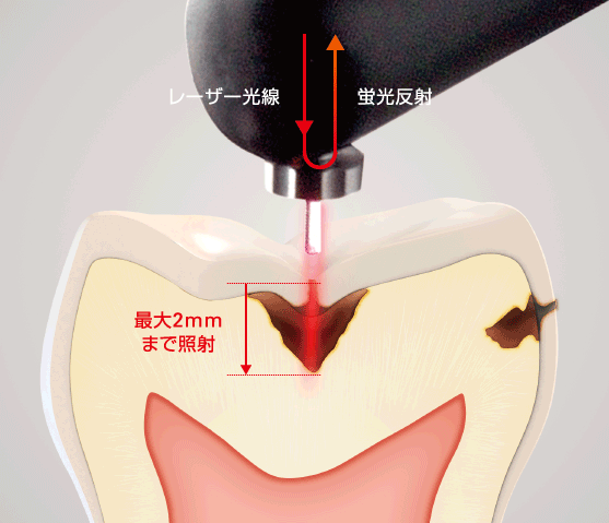 歯肉縁上のカリエスを数値で管理