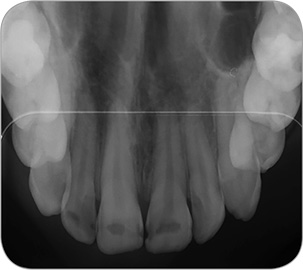 サイズ4 (Comfort Occlusal 4C)