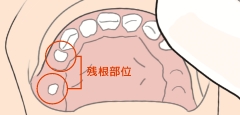 残根部位※の清掃にも適しています。※根っこだけ残った状態の歯