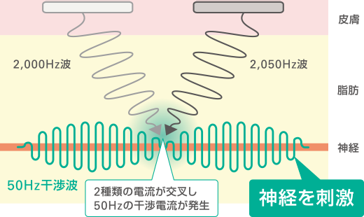 ジェントルスティムの干渉波刺激