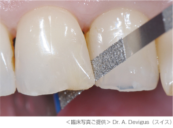 ＜臨床写真ご提供＞ Dr. A. Devigus（スイス）