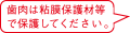 歯肉は粘膜保護材等で保護してください。