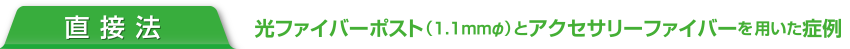直接法 光ファイバーポスト（1.1mmΦ）とアクセサリーファイバーを  用いた症例