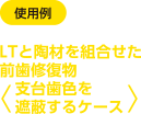 [使用例]LTと陶材を組合せた前歯修復物＜支台歯色を遮蔽するケース＞