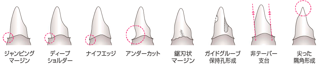 避けるべき支台歯形成