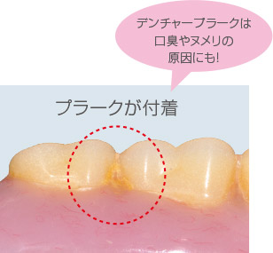 [写真]プラークが付着　デンチャープラークは口臭やヌメリの原因にも！