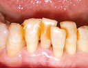 歯面処理のイメージ