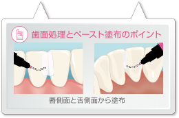 歯面処理とペースト塗布のポイント