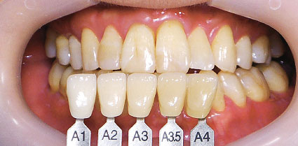歯列モードの写真