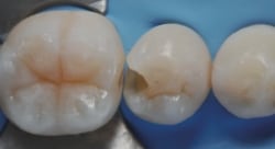 1.防湿、う蝕歯質の除去、窩洞形成