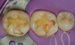 う蝕象牙質除去と窩洞形成