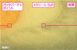 ガッタバーチャポイントと歯質と「メタシール Soft」の界面