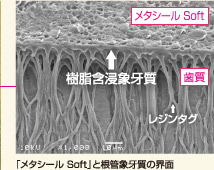 「メタシール Soft」と根管象牙質の界面