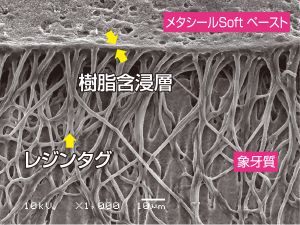 根管象牙質への接着